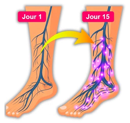 Boissons neuropathie