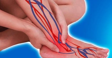 Neuropathie peripherique 650