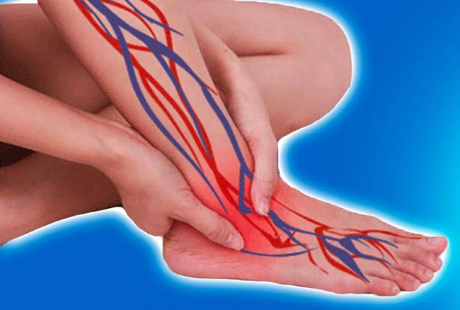 Neuropathie peripherique 650